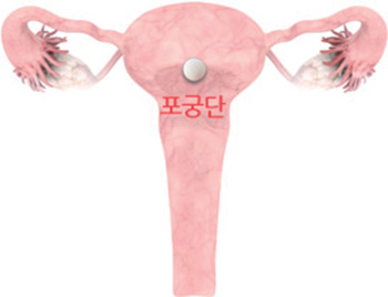 포궁단